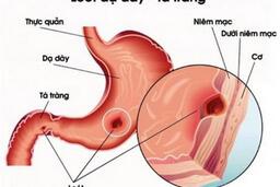 Dược thiện dành cho người bị viêm loét dạ dày tá tràng