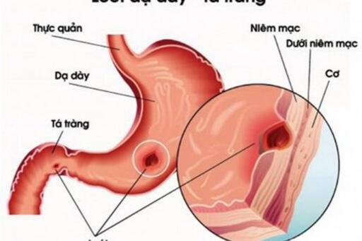 Dược thiện dành cho người bị viêm loét dạ dày tá tràng