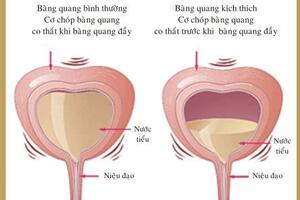 Các bài thuốc Đông y chữa Viêm bàng quang cấp tính