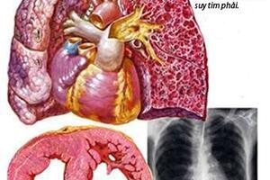 Y dược cổ truyền chữa ho do táo nhiệt