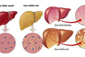 Gan nhiễm mỡ dễ dẫn đến xơ gan, viêm gan