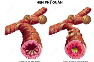 Trị viêm phế quản mạn tính theo kinh nghiệm của dân gian