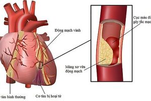 Bài thuốc dân gian hỗ trợ điều trị bệnh xơ vữa mạch vành