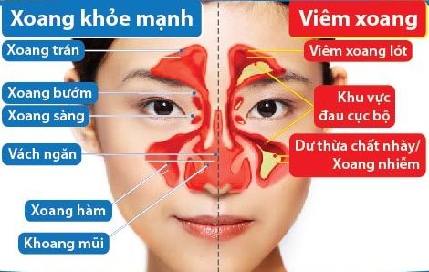 Bài thuốc dân gian trị viêm xoang mạn tính