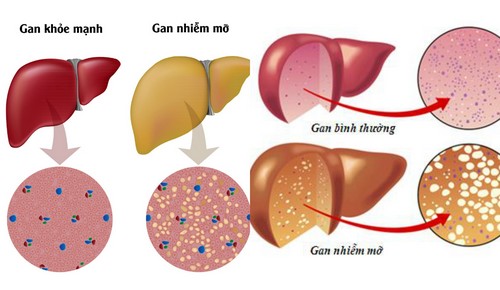 Gan nhiễm mỡ dễ dẫn đến xơ gan, viêm gan, ung thư gan