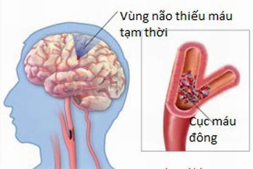 Thiêu năng tuân hoàn não
