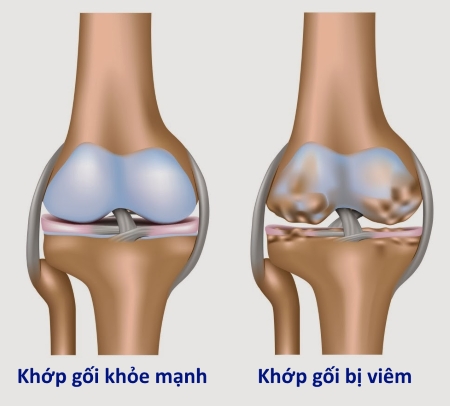 Viêm khớp dạng thấp