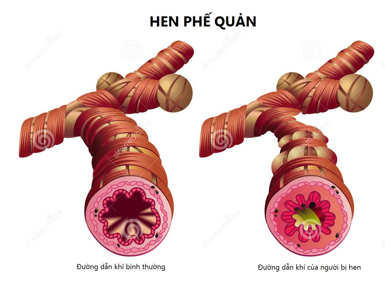 Viêm phế quản